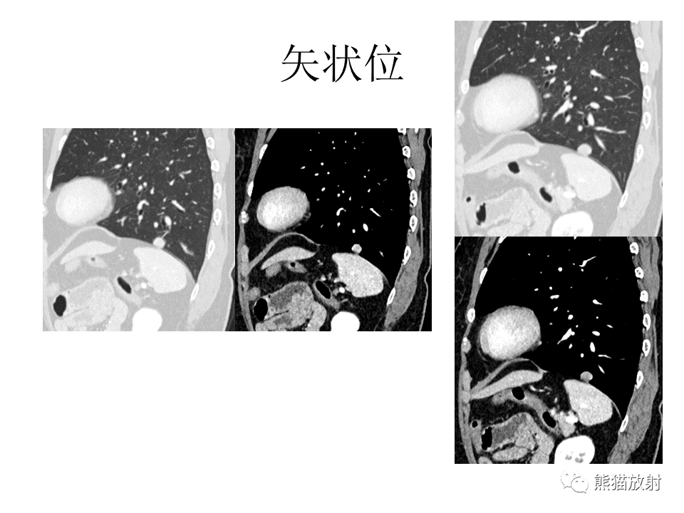 影像PPT - 【病例】肺浸润性腺癌2例CT影像-9
