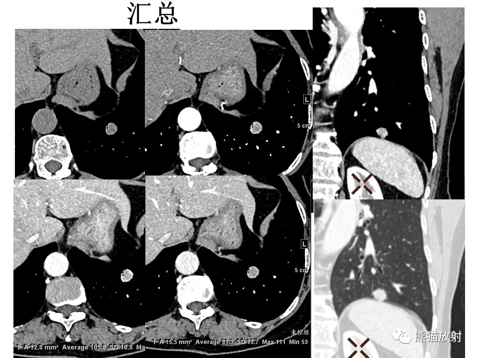 影像PPT - 【病例】肺浸润性腺癌2例CT影像-10