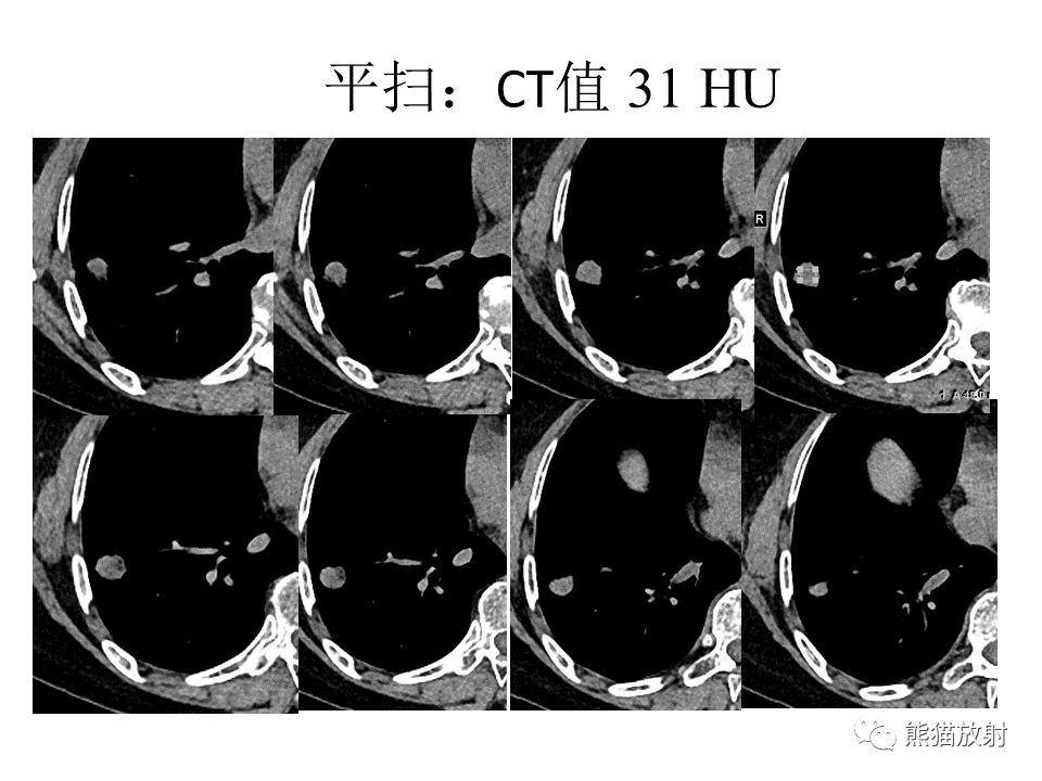 影像PPT - 【病例】肺浸润性腺癌2例CT影像-13