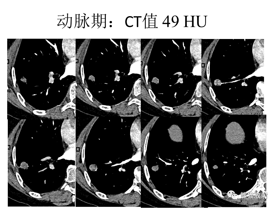 影像PPT - 【病例】肺浸润性腺癌2例CT影像-14