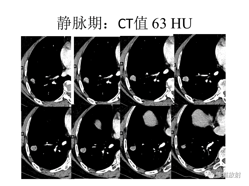 影像PPT - 【病例】肺浸润性腺癌2例CT影像-15