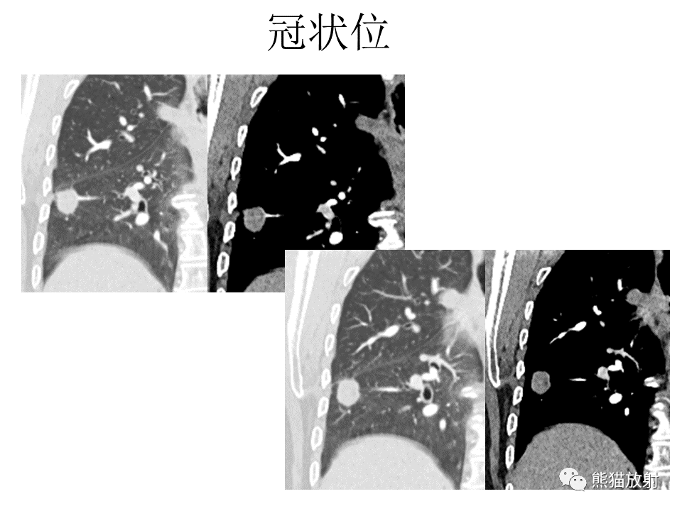 影像PPT - 【病例】肺浸润性腺癌2例CT影像-17