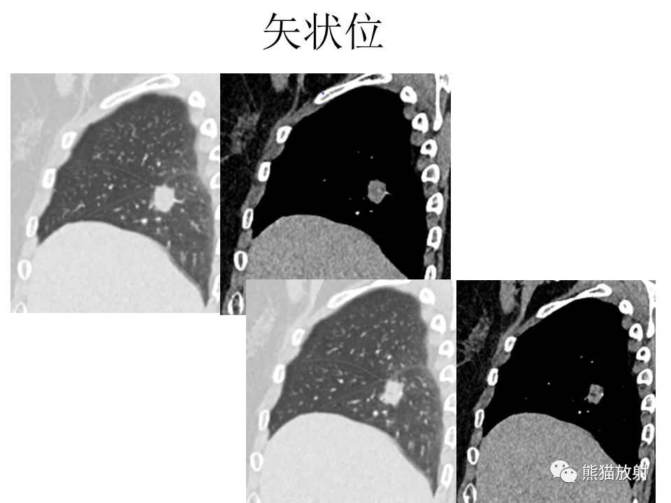 影像PPT - 【病例】肺浸润性腺癌2例CT影像-18