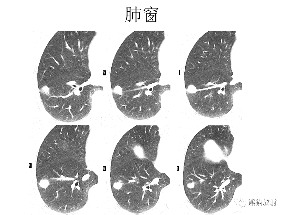 影像PPT - 【病例】肺浸润性腺癌2例CT影像-16