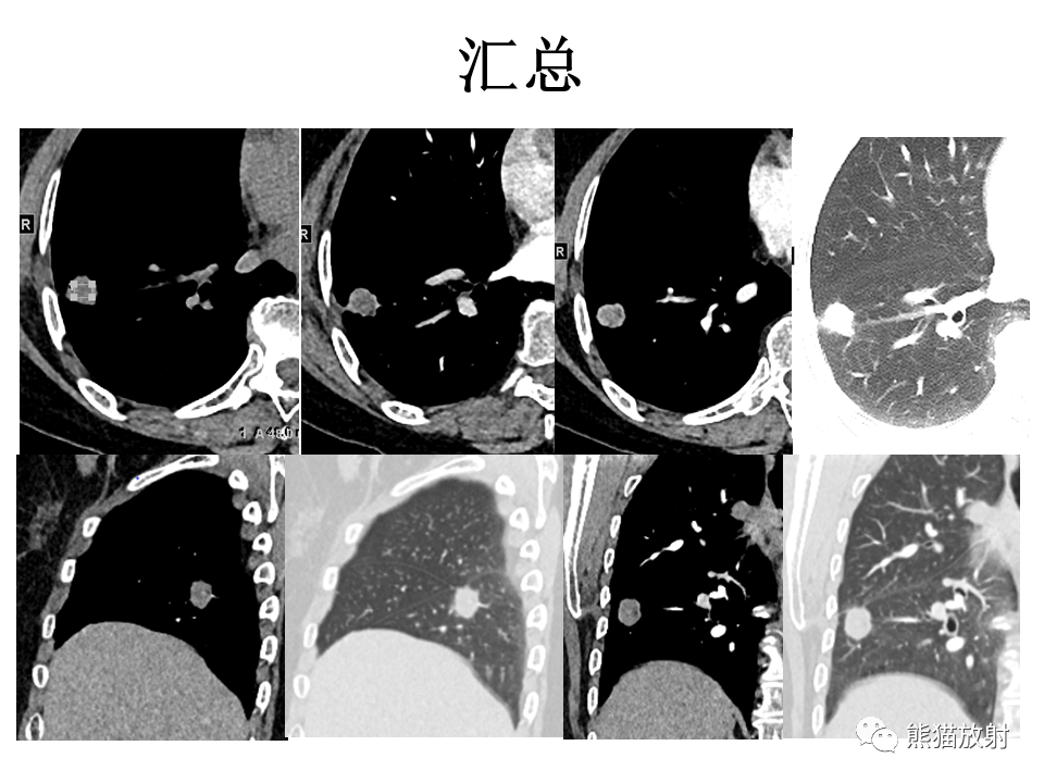 影像PPT - 【病例】肺浸润性腺癌2例CT影像-19