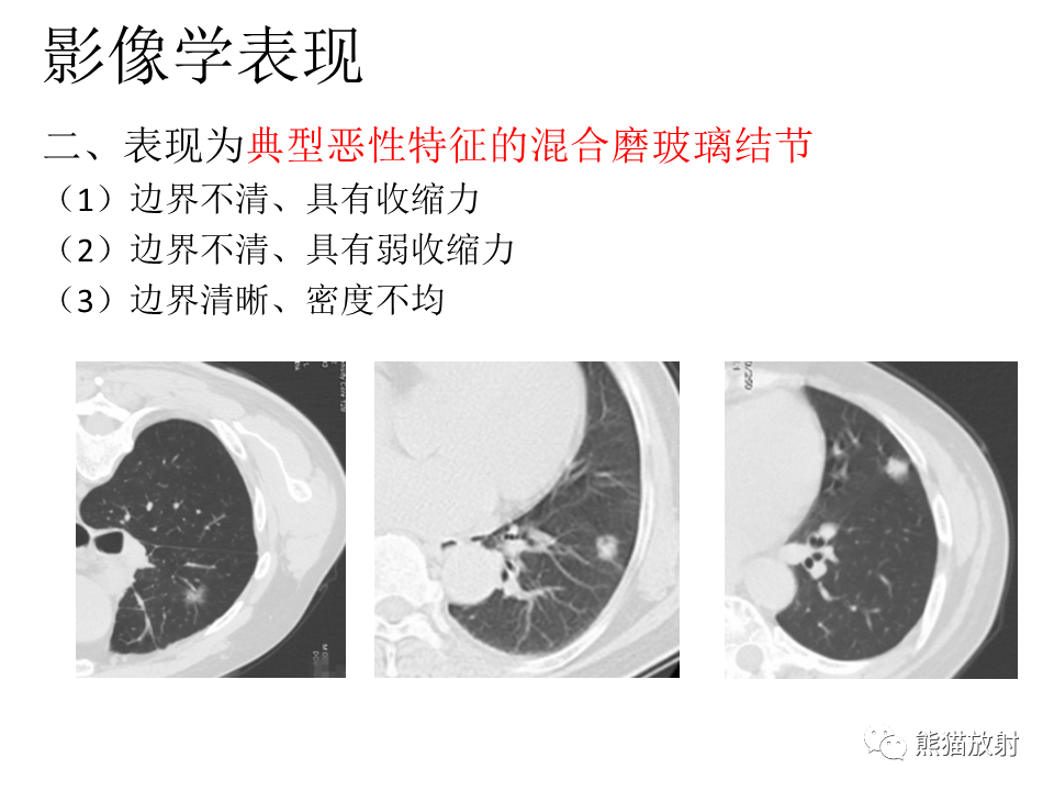 影像PPT - 【病例】肺浸润性腺癌2例CT影像-31