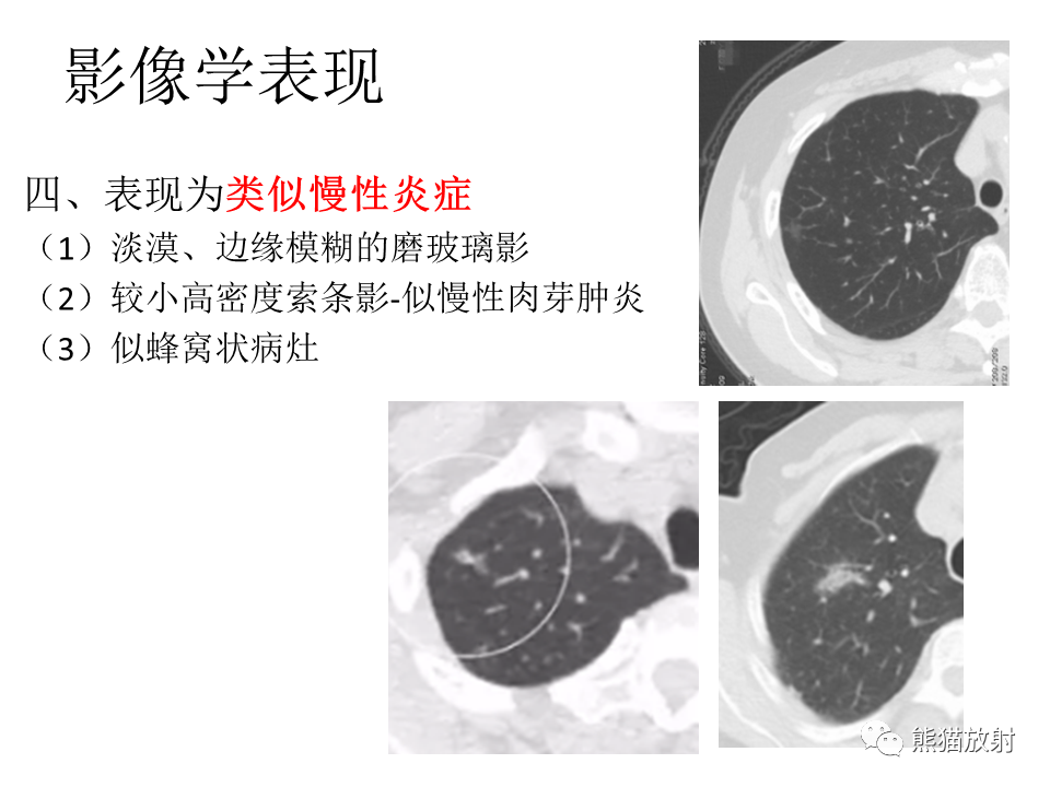 影像PPT - 【病例】肺浸润性腺癌2例CT影像-33