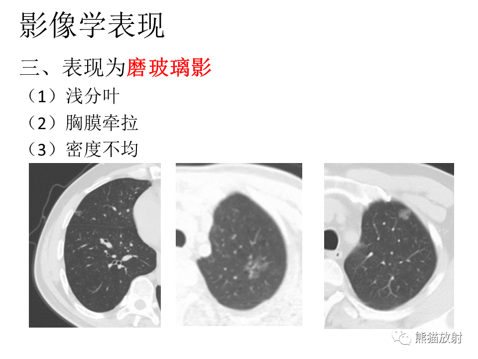 影像PPT - 【病例】肺浸润性腺癌2例CT影像-32