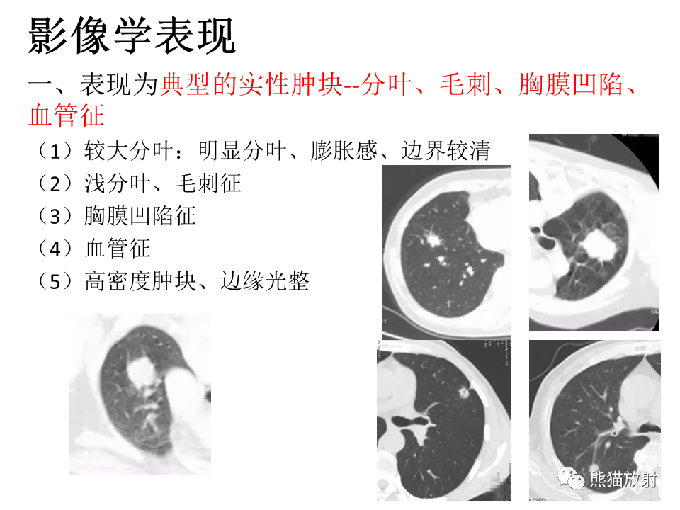 影像PPT - 【病例】肺浸润性腺癌2例CT影像-30