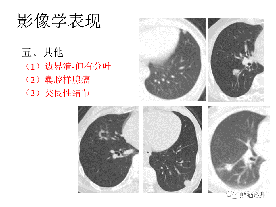 影像PPT - 【病例】肺浸润性腺癌2例CT影像-34