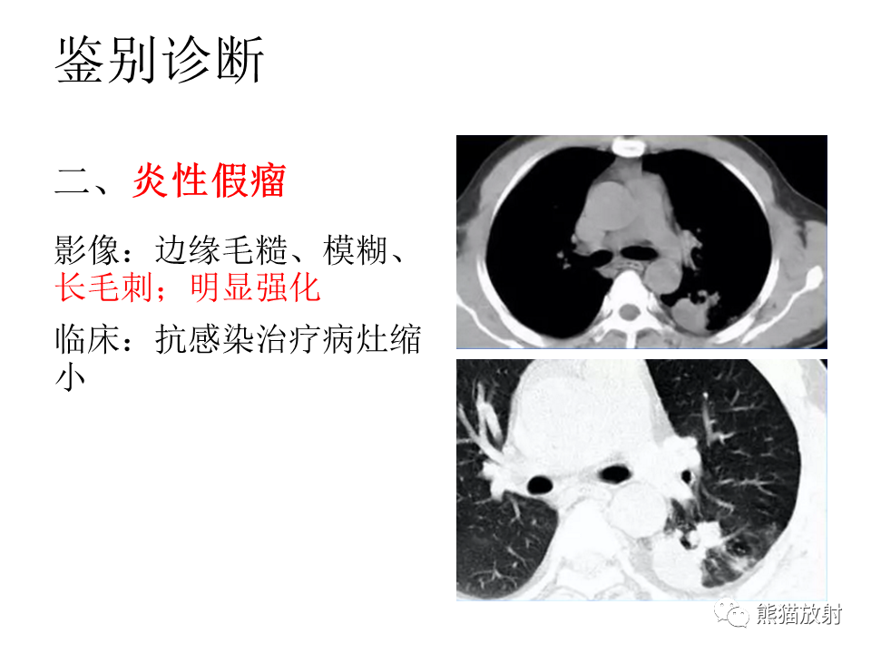 影像PPT - 【病例】肺浸润性腺癌2例CT影像-37