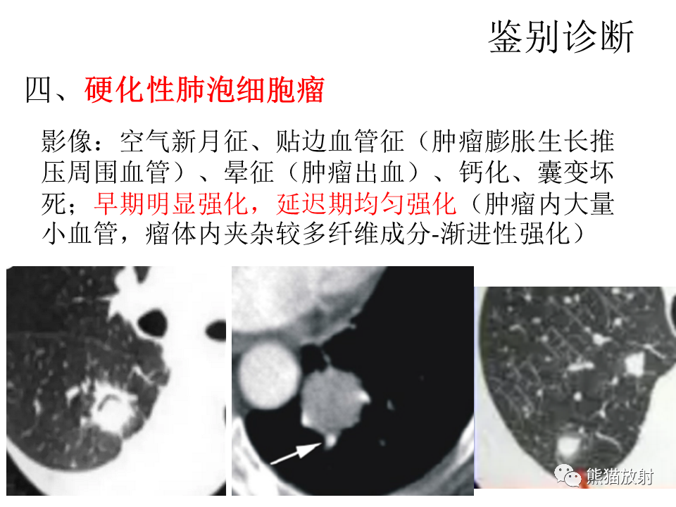 影像PPT - 【病例】肺浸润性腺癌2例CT影像-39