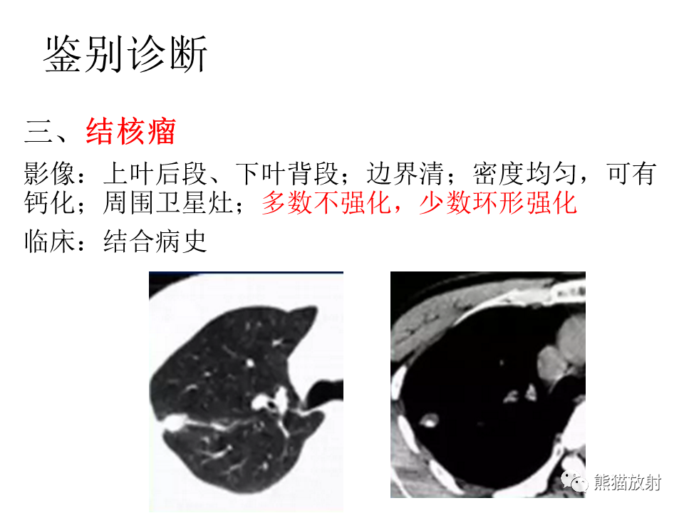 影像PPT - 【病例】肺浸润性腺癌2例CT影像-38