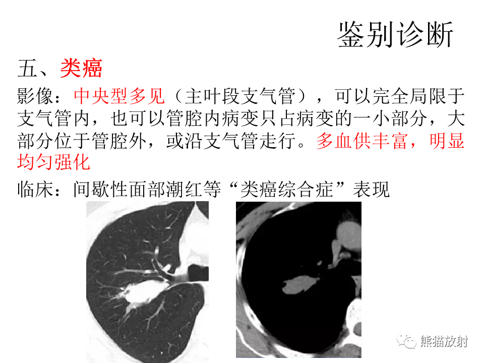 影像PPT - 【病例】肺浸润性腺癌2例CT影像-40