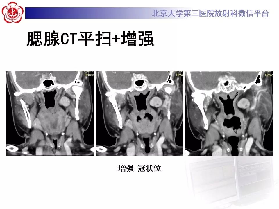 影像PPT - 【PPT】咽旁间隙基底细胞腺瘤的影像-5