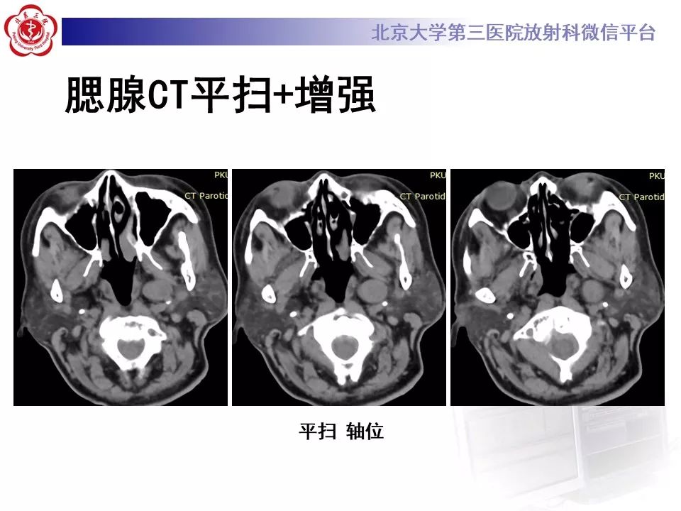 影像PPT - 【PPT】咽旁间隙基底细胞腺瘤的影像-3