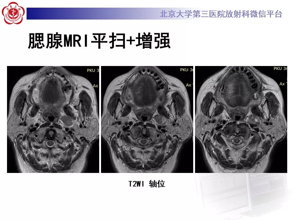 影像PPT - 【PPT】咽旁间隙基底细胞腺瘤的影像-6