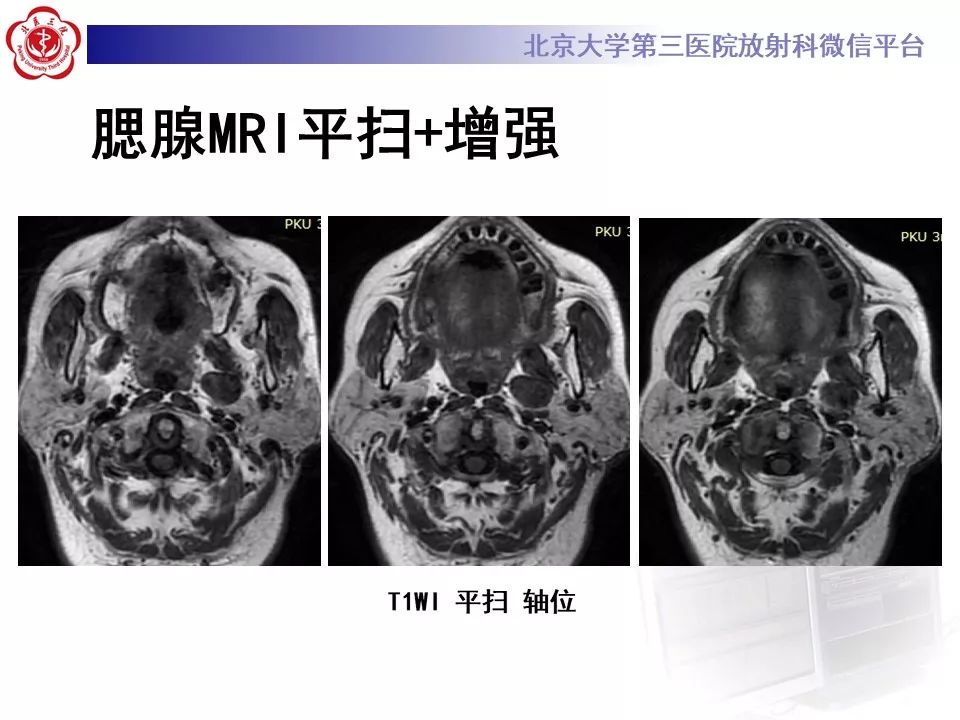影像PPT - 【PPT】咽旁间隙基底细胞腺瘤的影像-7