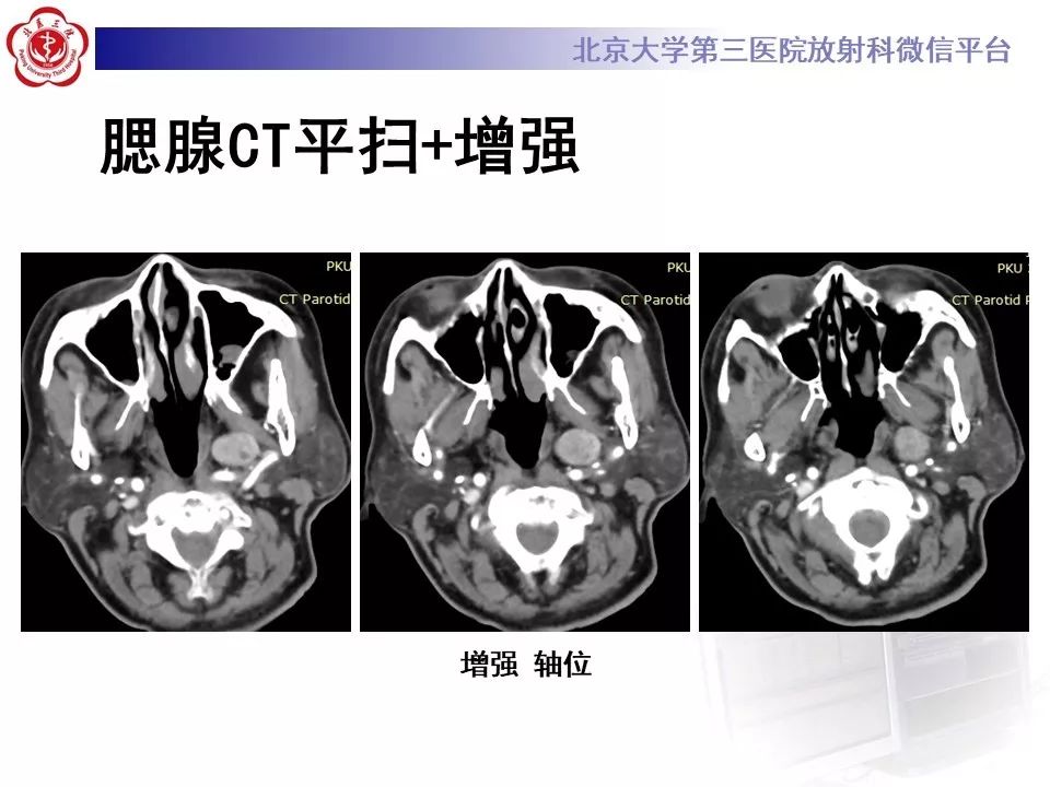 影像PPT - 【PPT】咽旁间隙基底细胞腺瘤的影像-4