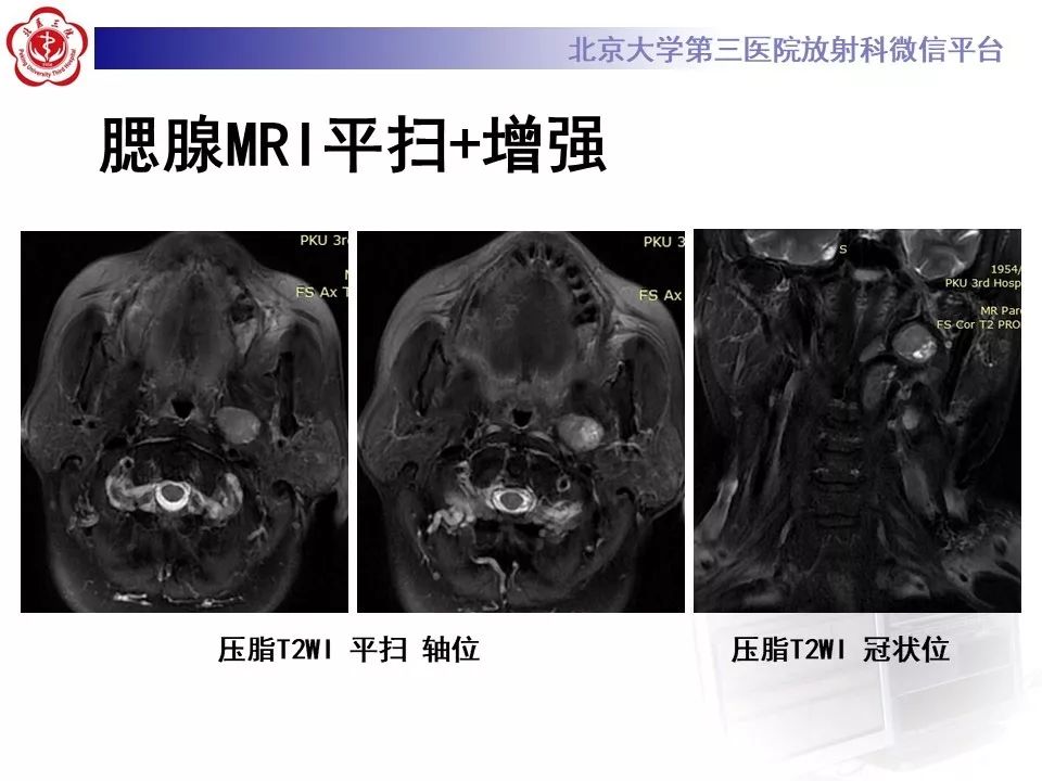影像PPT - 【PPT】咽旁间隙基底细胞腺瘤的影像-8