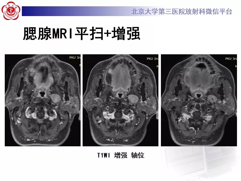 影像PPT - 【PPT】咽旁间隙基底细胞腺瘤的影像-9