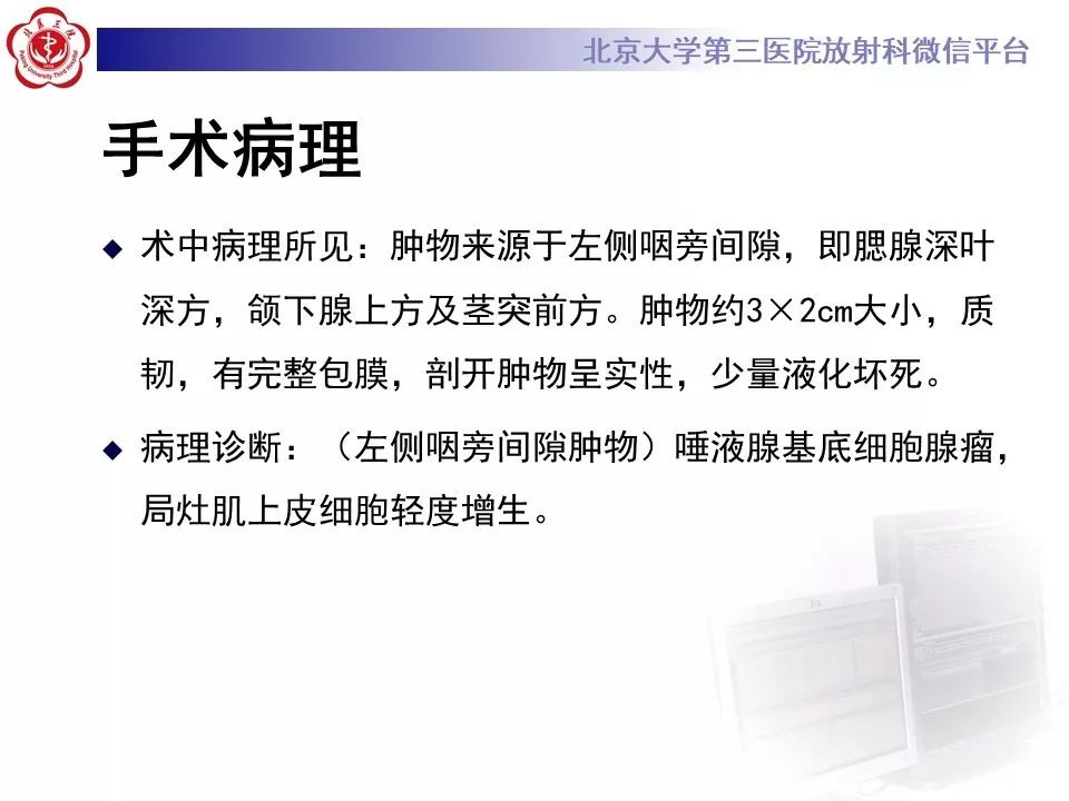 影像PPT - 【PPT】咽旁间隙基底细胞腺瘤的影像-11