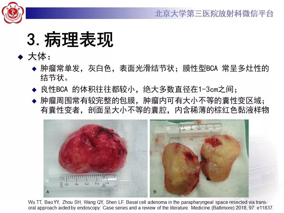 影像PPT - 【PPT】咽旁间隙基底细胞腺瘤的影像-17