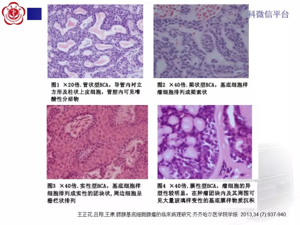 影像PPT - 【PPT】咽旁间隙基底细胞腺瘤的影像-19