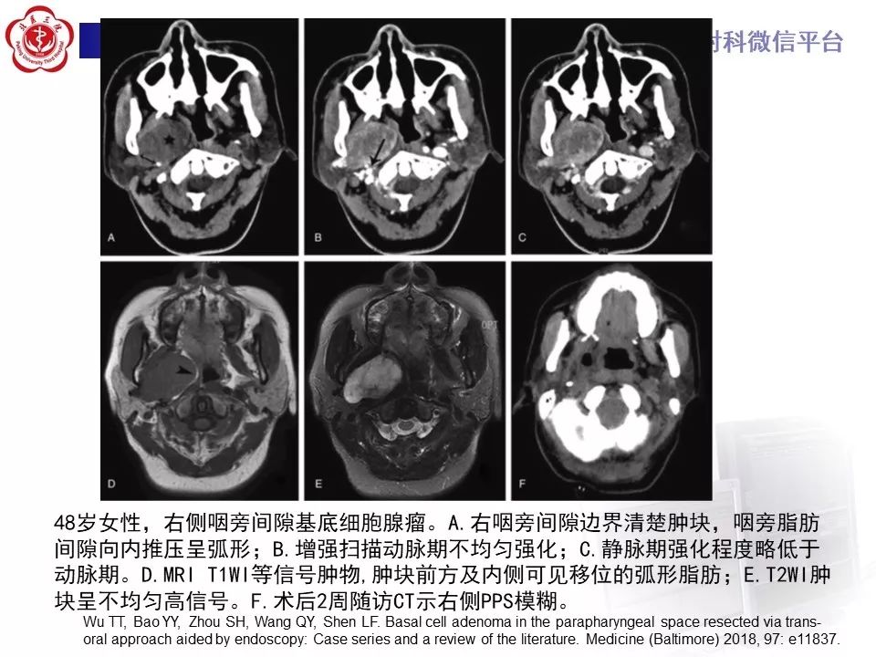 影像PPT - 【PPT】咽旁间隙基底细胞腺瘤的影像-23
