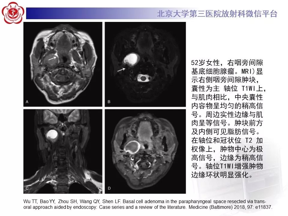 影像PPT - 【PPT】咽旁间隙基底细胞腺瘤的影像-24