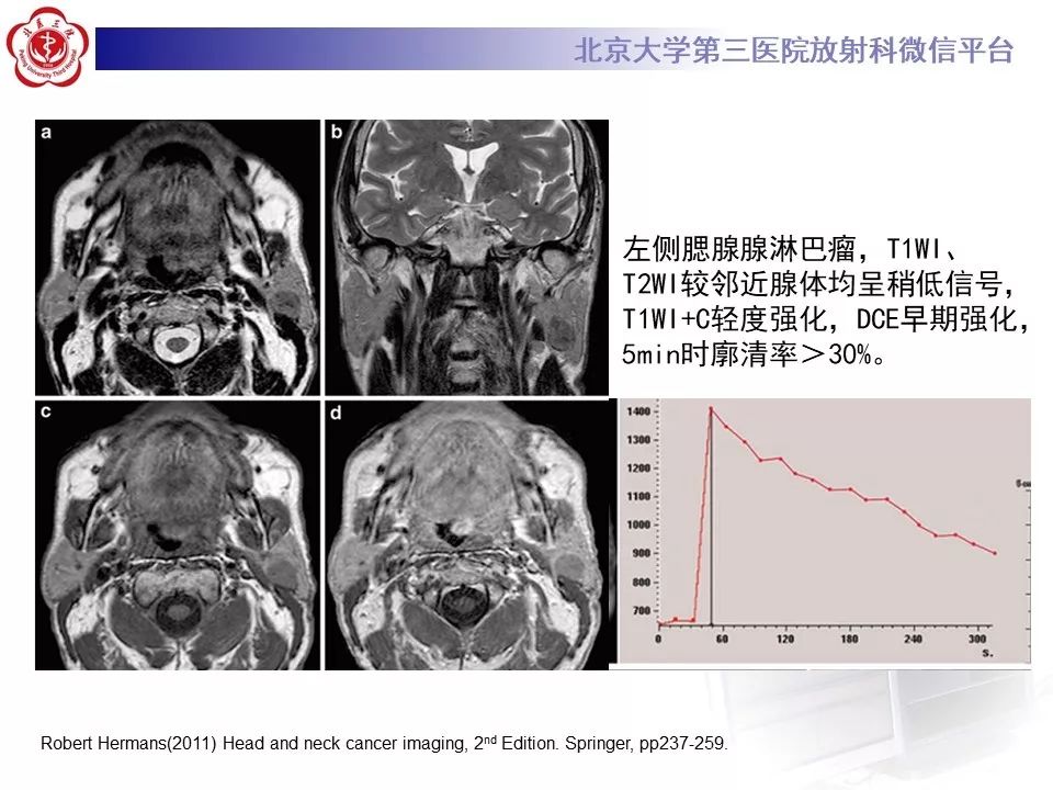 影像PPT - 【PPT】咽旁间隙基底细胞腺瘤的影像-30