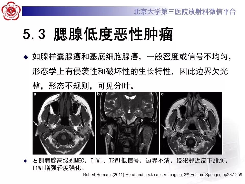 影像PPT - 【PPT】咽旁间隙基底细胞腺瘤的影像-31