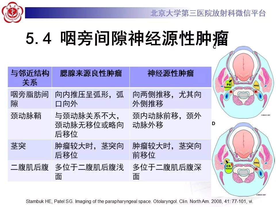 影像PPT - 【PPT】咽旁间隙基底细胞腺瘤的影像-33