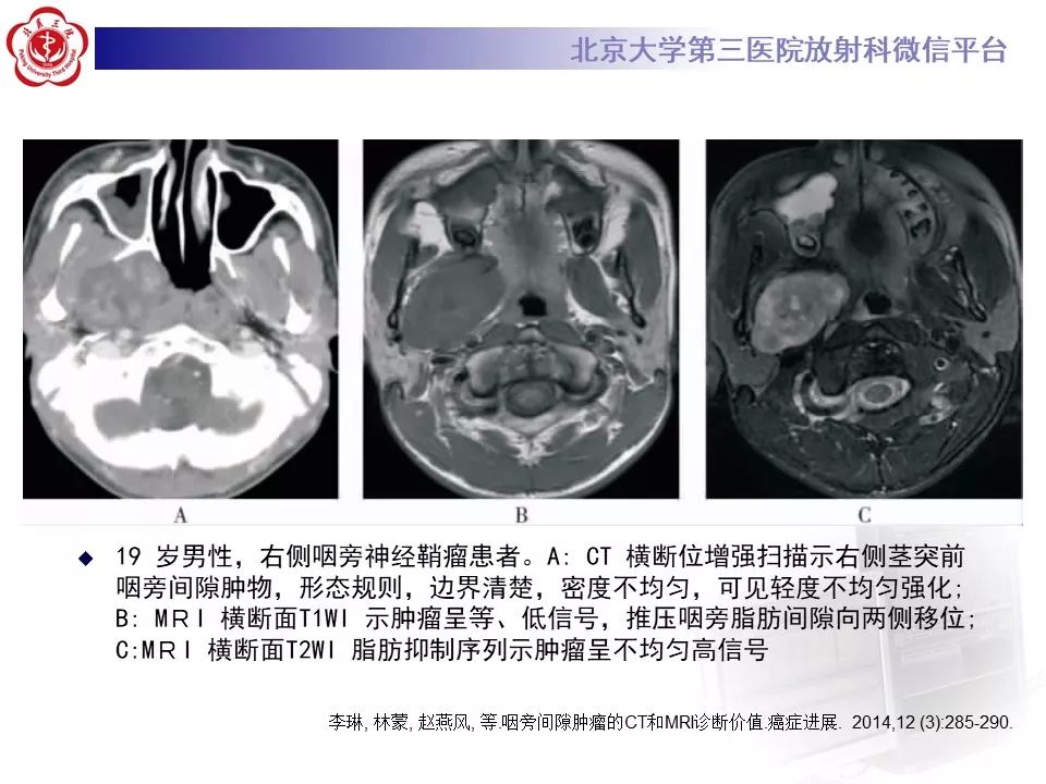 影像PPT - 【PPT】咽旁间隙基底细胞腺瘤的影像-34