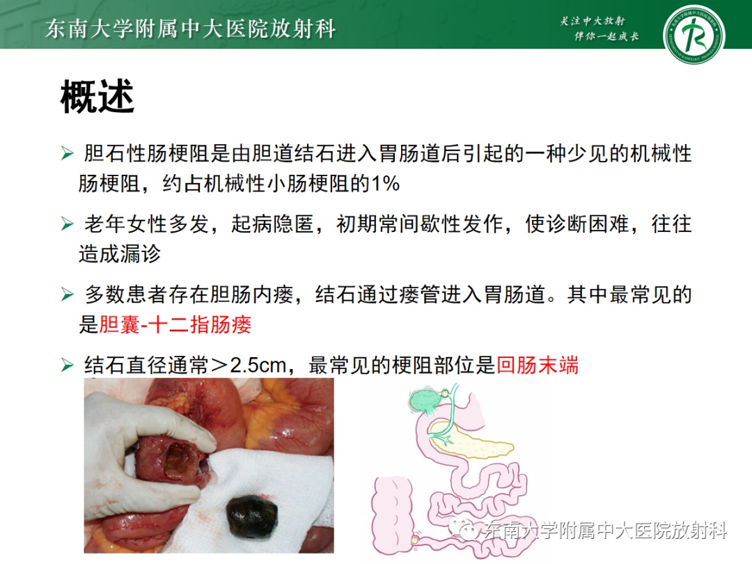 影像PPT - 【PPT】胆石性肠梗阻-4