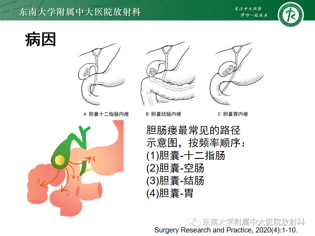 影像PPT - 【PPT】胆石性肠梗阻-6