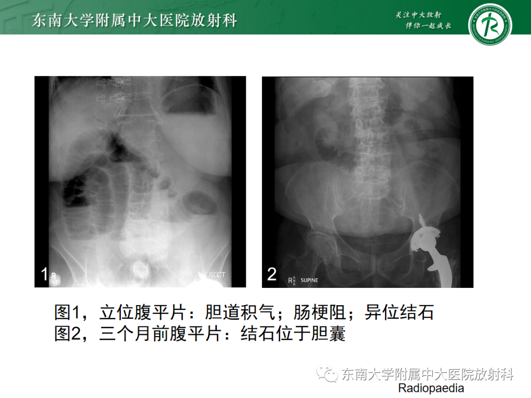 影像PPT - 【PPT】胆石性肠梗阻-12