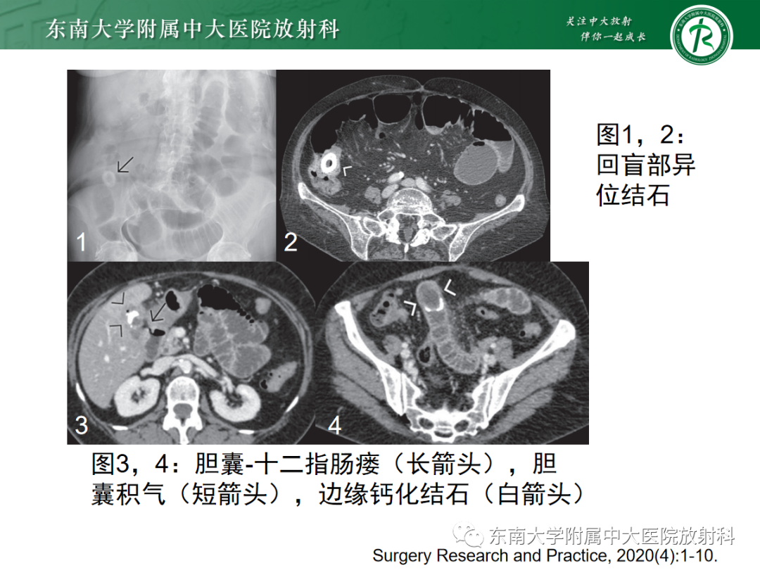 影像PPT - 【PPT】胆石性肠梗阻-13