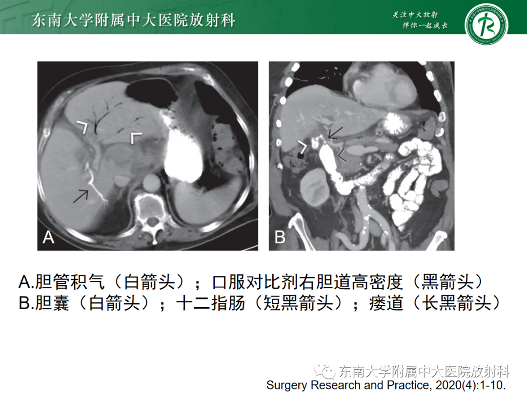 影像PPT - 【PPT】胆石性肠梗阻-14