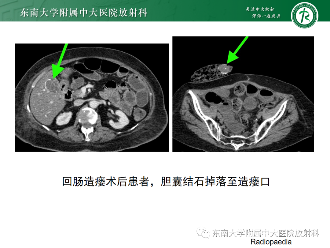 影像PPT - 【PPT】胆石性肠梗阻-16