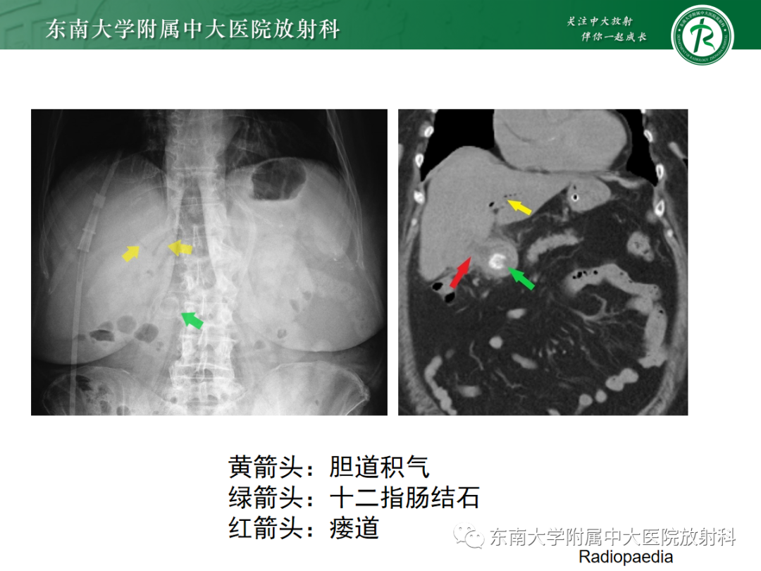 影像PPT - 【PPT】胆石性肠梗阻-15