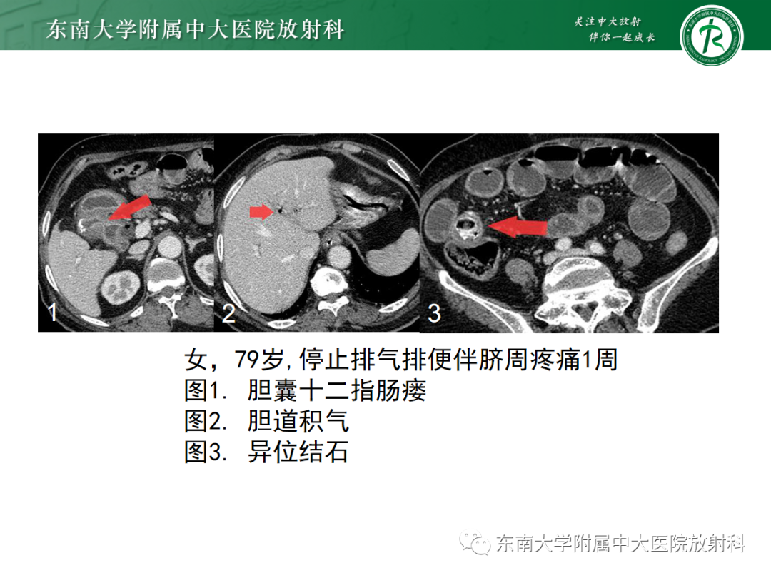 影像PPT - 【PPT】胆石性肠梗阻-17
