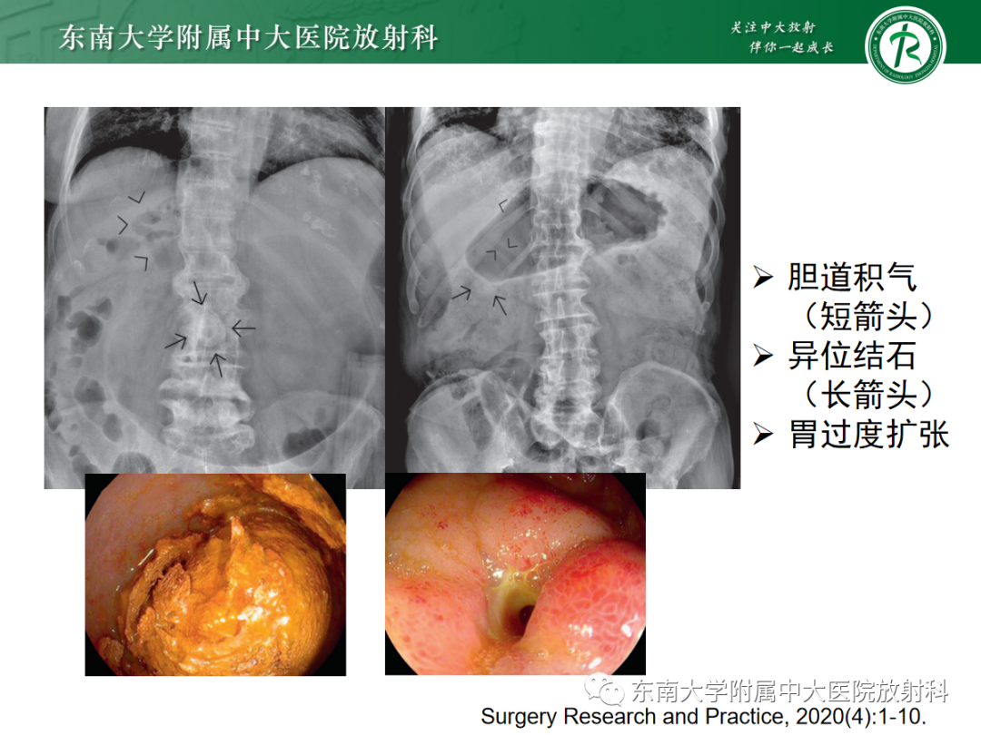 影像PPT - 【PPT】胆石性肠梗阻-19