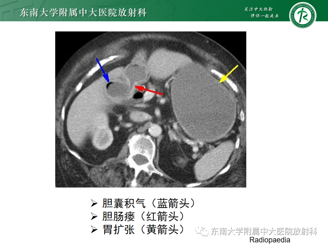 影像PPT - 【PPT】胆石性肠梗阻-20