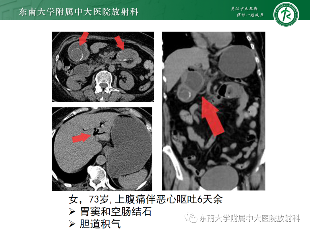影像PPT - 【PPT】胆石性肠梗阻-22
