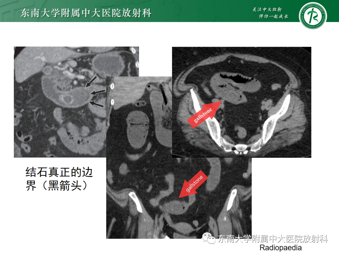 影像PPT - 【PPT】胆石性肠梗阻-24