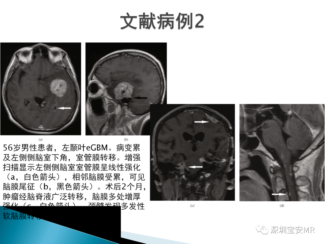 影像PPT - 【病例】上皮样胶质母细胞瘤1例MR-8