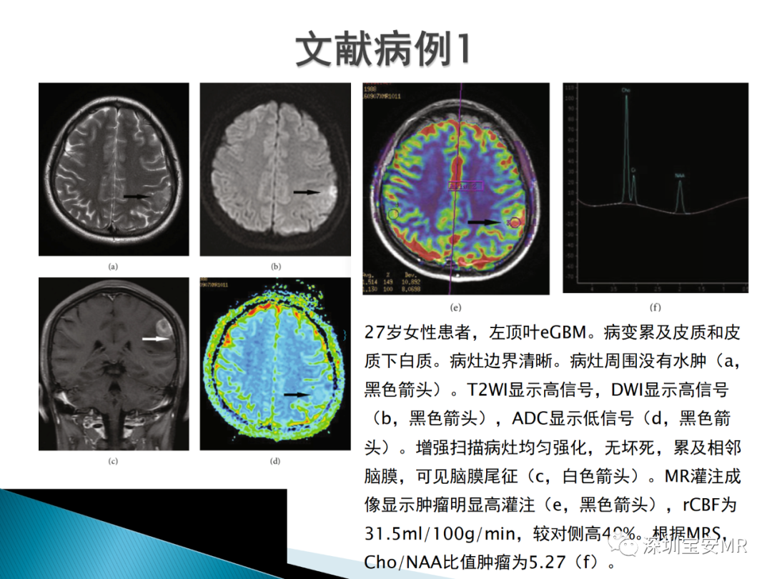 影像PPT - 【病例】上皮样胶质母细胞瘤1例MR-7