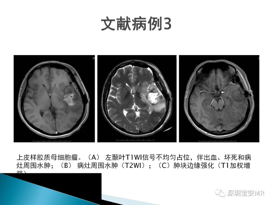影像PPT - 【病例】上皮样胶质母细胞瘤1例MR-9