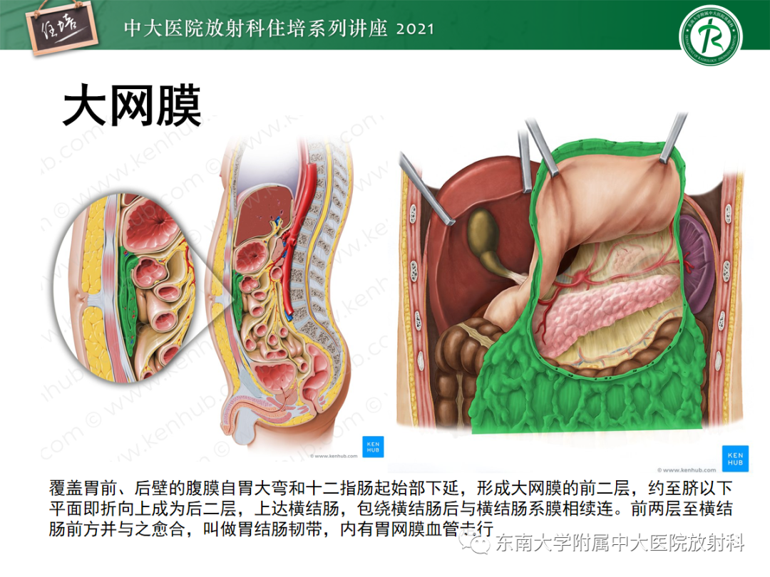 影像PPT - 【PPT】腹膜病变的影像分析思路-3